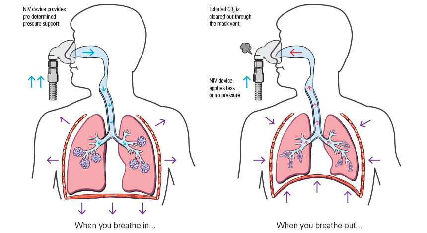 Non-invasive ventilation for COPD. Can it help?
